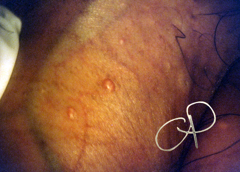papilloma virus uomo diagnosi