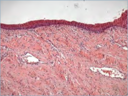 Mucosa vaginale atrofica: l'epitelio  sottile e la lamina propria ha perso i vasi e le papille